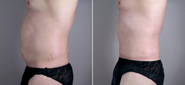Side view of male patient before and after abdominoplasty