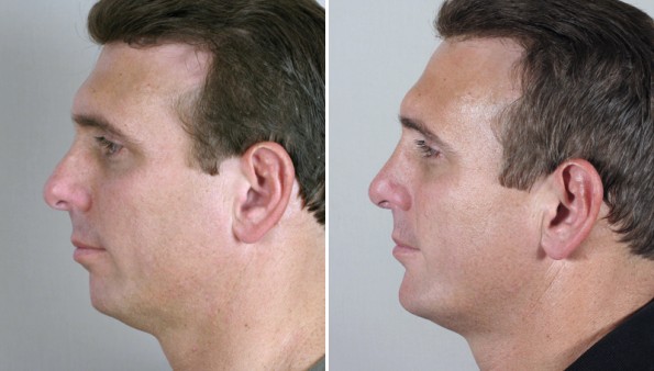 Male patient before and after chin augmentation