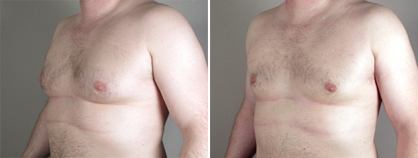 Front view of man\'s chest before and after gynecomastia treatment