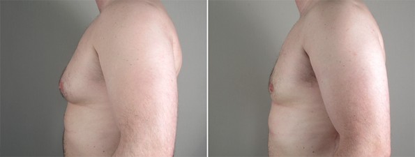 Side view of man\'s chest before and after gynecomastia treatment