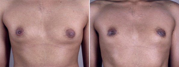 Male Gynecomastia Treatment Before & After