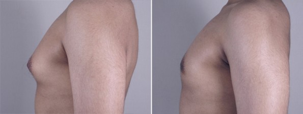 Side view of male patient before and after gynecomastia treatment