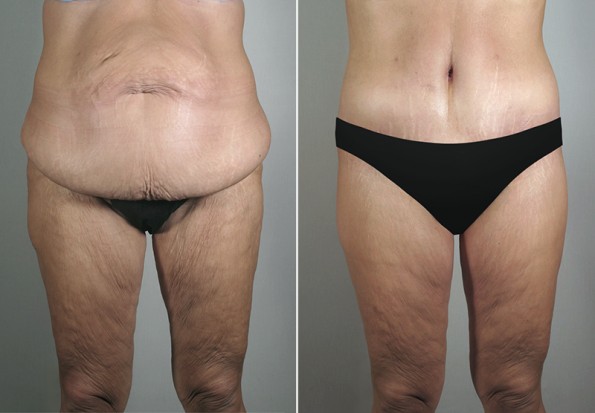 Front view of woman\'s abdomen before and after mommy makeover surgery