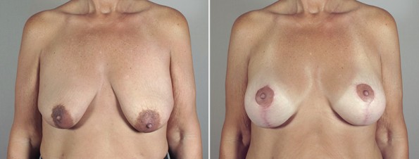 Front view of woman\'s chest before and after mommy makeover surgery