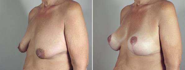 Side view of woman\'s chest before and after mommy makeover surgery