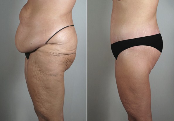 Side view of woman\'s abdomen before and after mommy makeover surgery