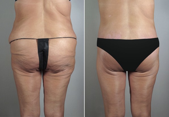 Back view of woman before and after mommy makeover surgery