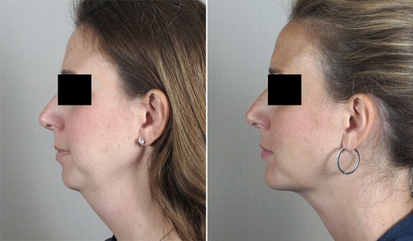Woman\'s profile before and after chin augmentation
