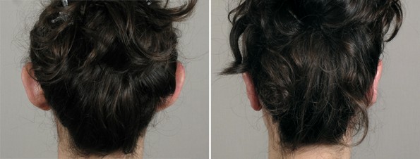 Back view of patient\'s head before and after otoplasty