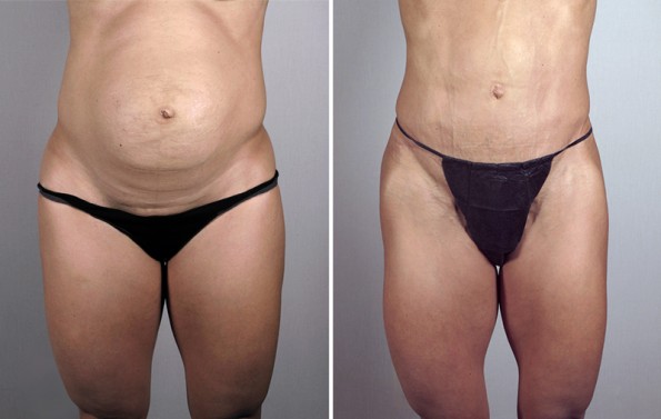 Front view of woman before and after lipoabdominoplasty