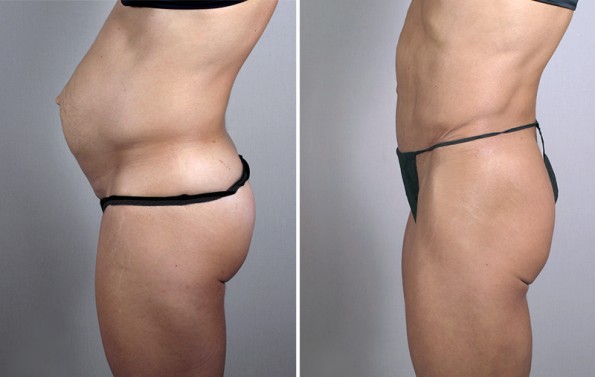 Side view of woman before and after lipoabdominoplasty