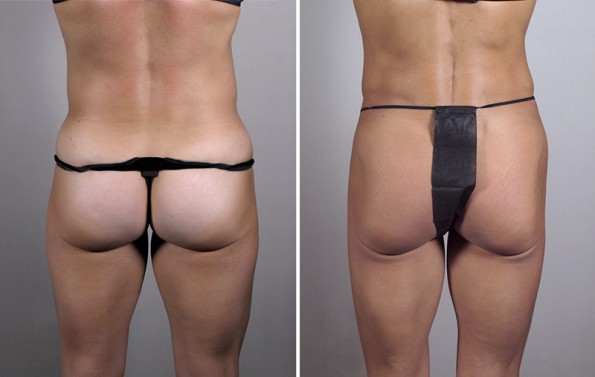 Back view of woman before and after lipoabdominoplasty