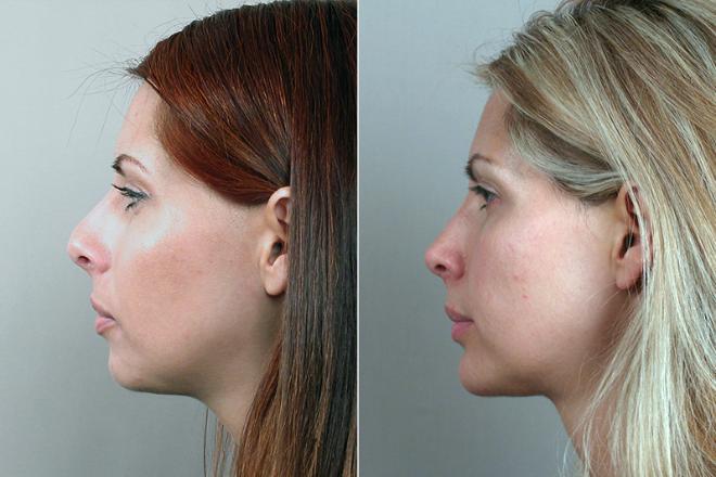Profile of young woman before and after rhinoplasty