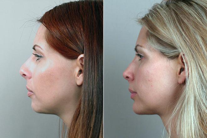 average nose job cost nyc