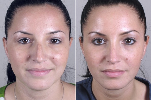 Rhinoplasty Before & After