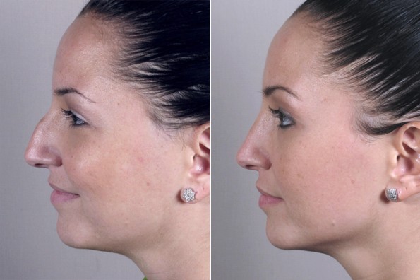 Rhinoplasty Before & After