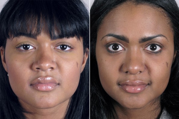 New Jersey Rhinoplasty Patient Before & After