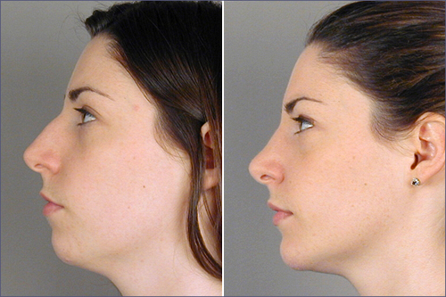 Profile of young woman before and after rhinoplasty