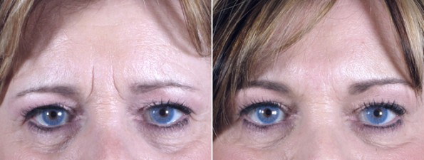 Woman\'s eyes before and after upper eyelid surgery