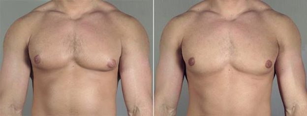 Front view of male patient before and after gynecomastia surgery