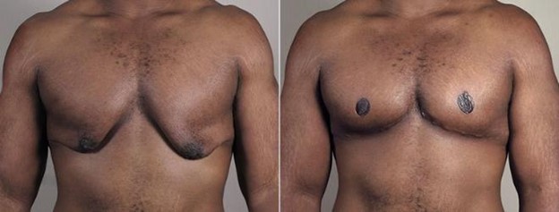 Front view of male patient before and after male breast reduction