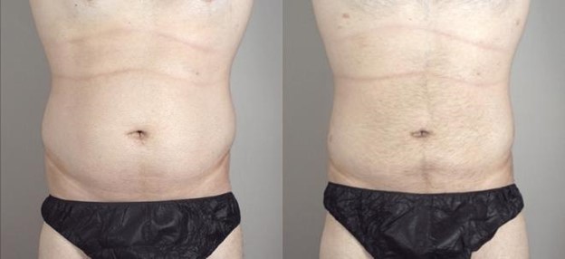 Male liposuction