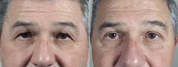 Male patient before and after eyelid surgery