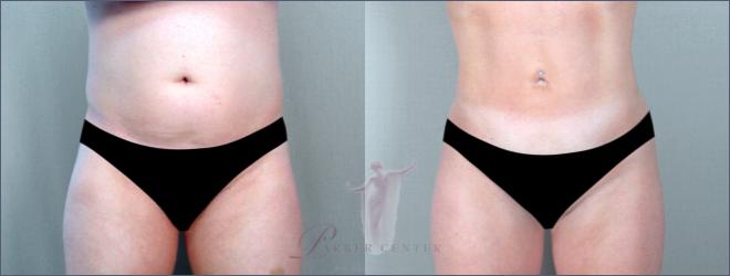 Woman\'s torso before and after abdominal liposuction