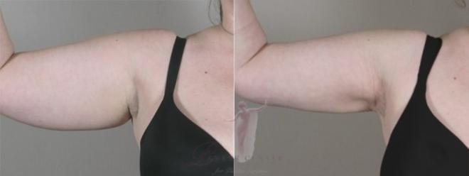 Woman\'s upper arm before and after liposuction