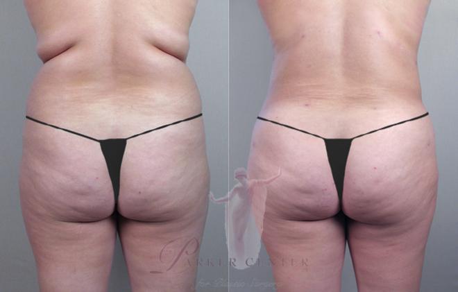 Woman before and after back liposuction