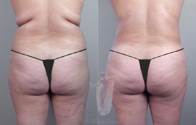 Mujer antes y después de la liposucción de espalda