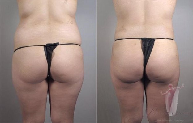 Back view of woman before and after Brazilian butt lift