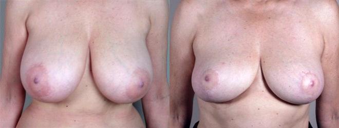 Woman\'s chest before and after breast reduction