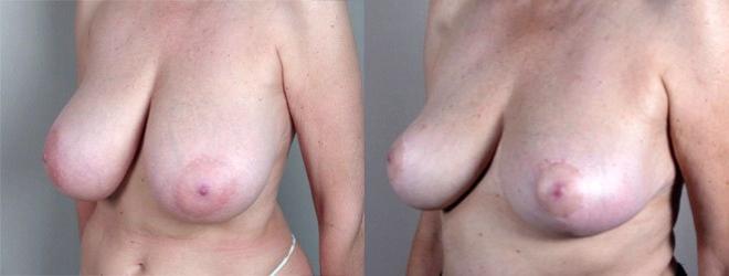 Side view of woman before and after breast reduction