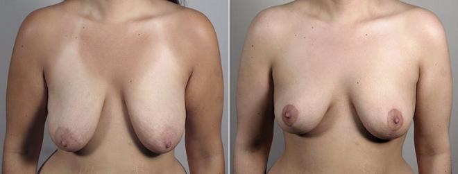 Front view of woman before and after breast lift