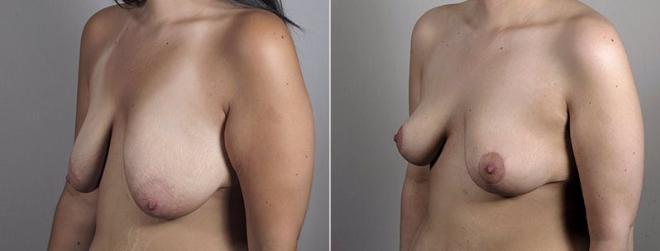 Side view of woman before and after breast lift