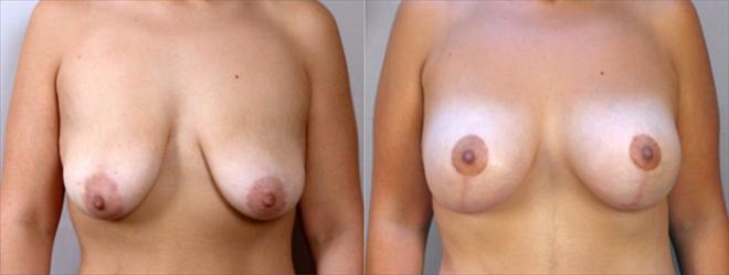 Front view of woman before and after breast lift with implants