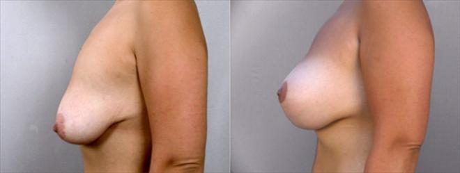 Side view of woman\'s chest before and after breast lift with implants