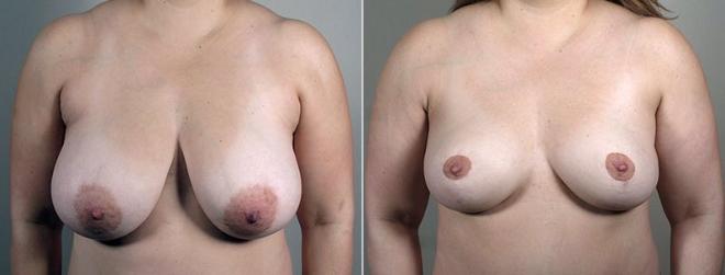Woman\'s chest before and after breast reduction