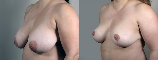 Side view of woman before and after breast reduction