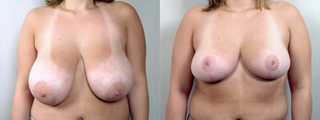 Woman\'s chest before and after breast reduction