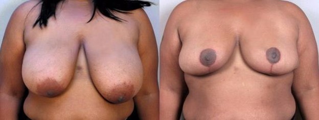Woman's chest before and after breast reduction