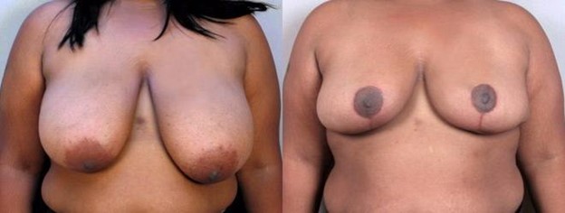 Woman\'s chest before and after breast reduction