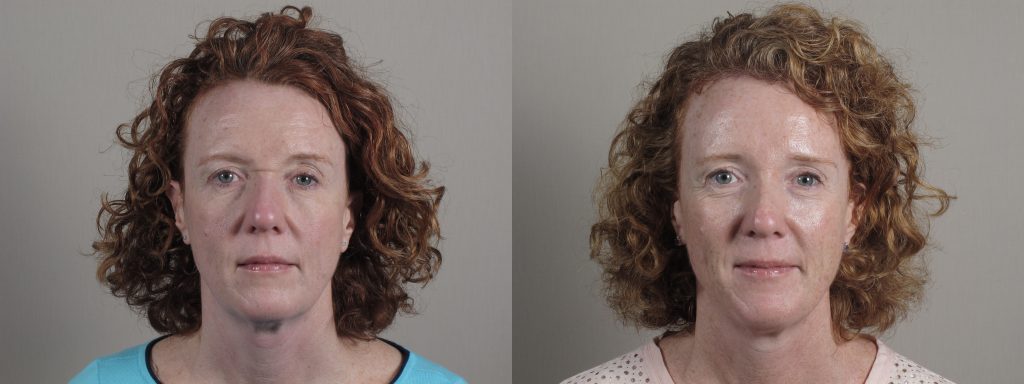 Woman\'s face before and after brow lift