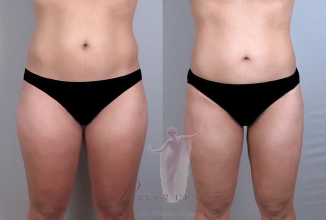 Woman before and after liposuction of the hips