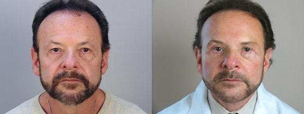 Man before and after facelift