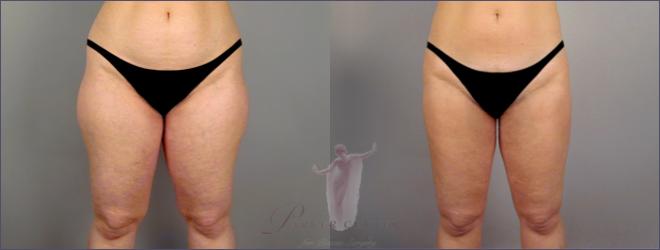 Vista frontal de los muslos de la mujer antes y después de la liposucción