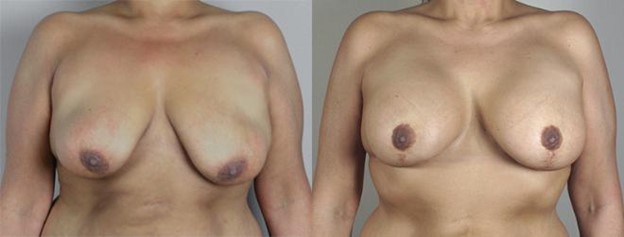 Woman\'s chest before and after breast reduction