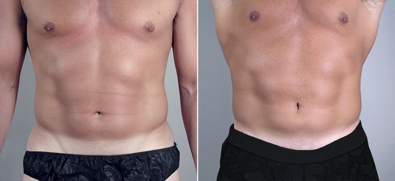 Male Waist, Sides and Flanks