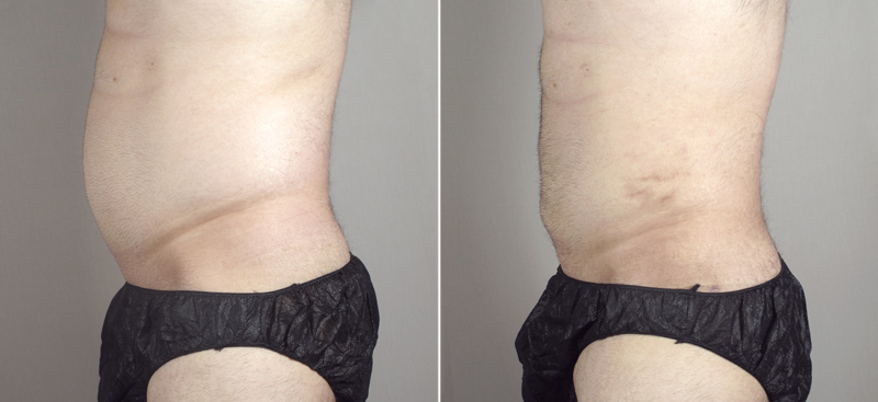 Side view of male patient before and after abdominoplasty